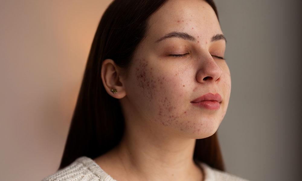 Causes of acne