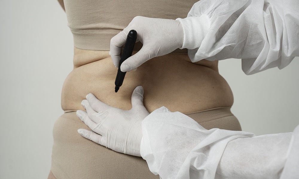 Cryolipolysis process