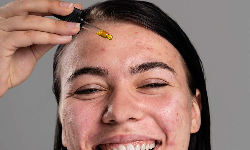 Retinol for acne