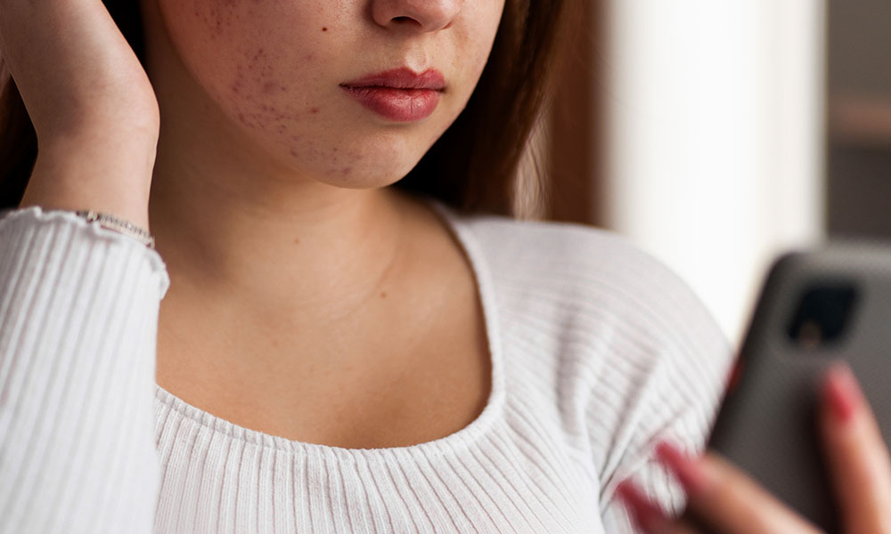 Treating hormonal acne