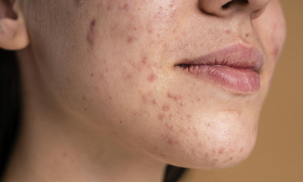 Tretinoin for acne scars