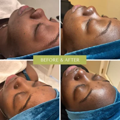 Beautiful young girl with beauty face before and after Skin Treatment | Forever Young Medi Spa in Sugar Land, Texas