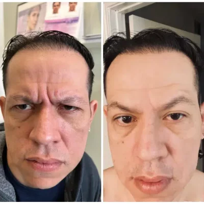 before-and-after-Botox