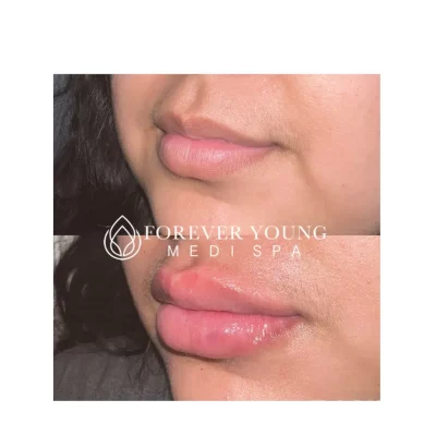 Lips before and after Lip filler injections | Forever Young Medi Spa in Sugar Land, Texas