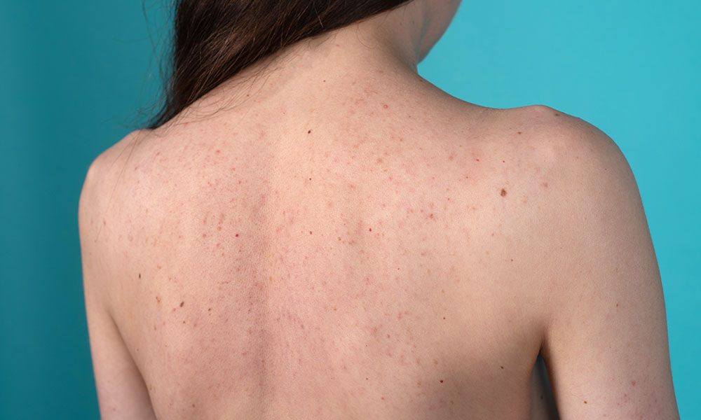 Back acne in females