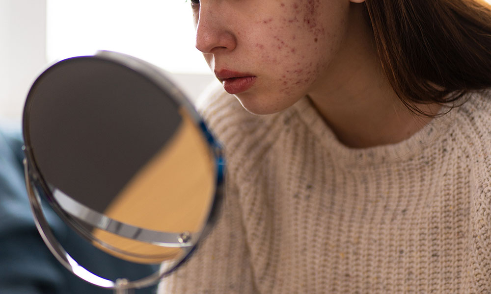 Removing acne scars